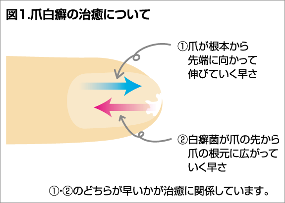 爪白癬の治癒について（図1）